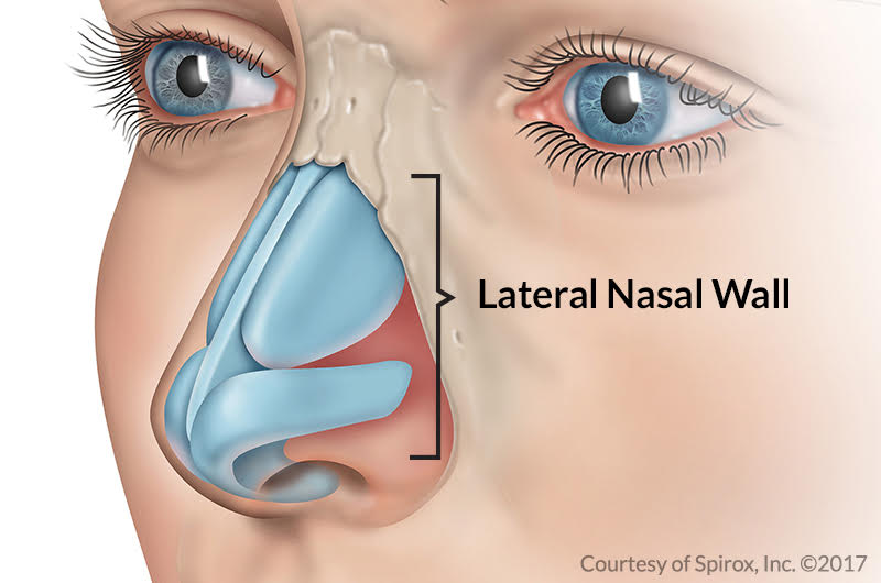 VivAer® for Nasal Airway Remodeling Ascentist Healthcare